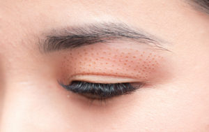 Βλεφαροπλαστική ή Plexr;