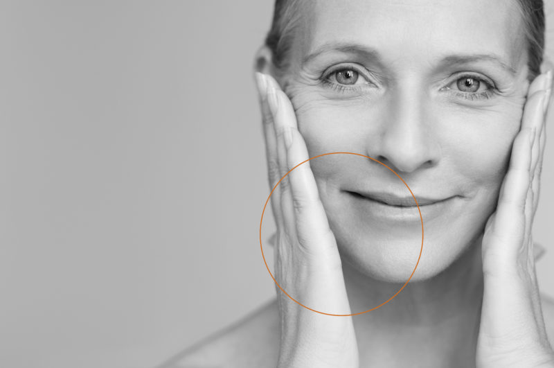 Facelift