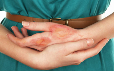 Έγκαυμα – Μετεγκαυματικές Επιπλοκές