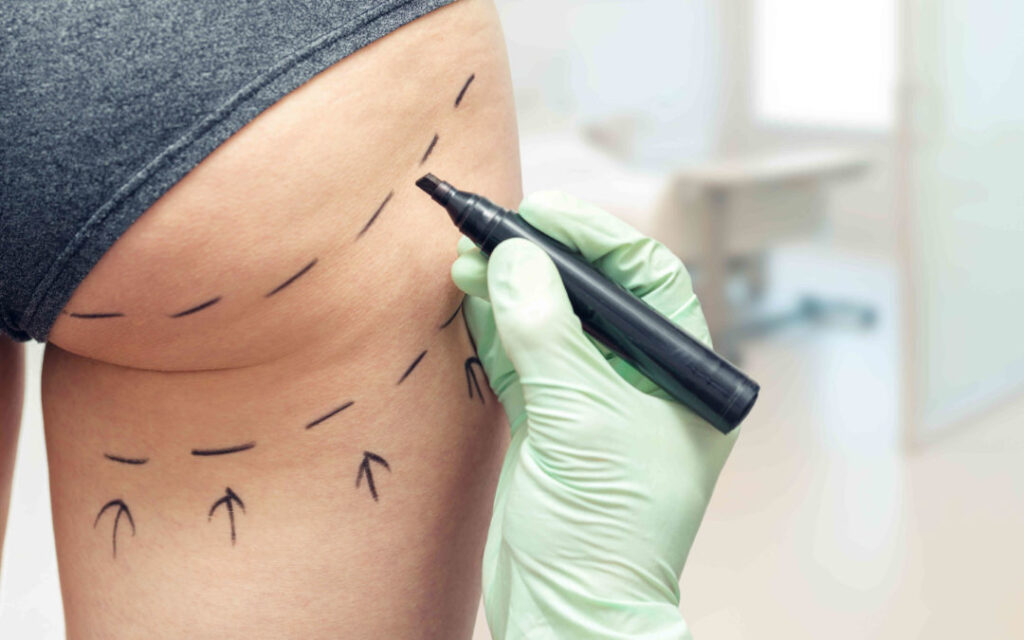 Ανόρθωση γλουτών