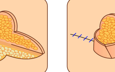 Αποκατάσταση θηλής/ Άλου