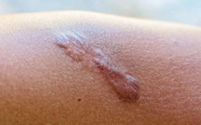 Βελτίωση ουλών