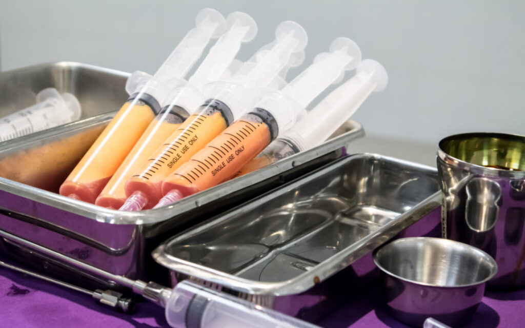 Λιπομεταμόσχευση